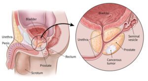 A diagram of prostate cancer and the procedure.