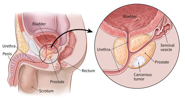 A description showing Prostate cancer