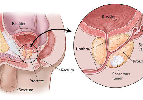 A description showing Prostate cancer